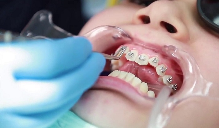 goroi.vn_Nguyên nhân gây ra vết ố sau khi niềng răng và cách để loại bỏ chúng